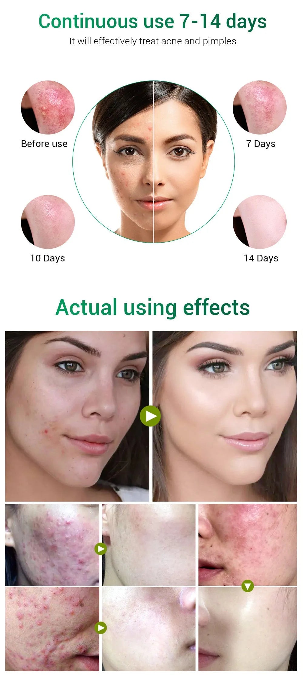 BREYLEE Tea Tree Acne Cream in a white jar with green lid for acne scar reduction